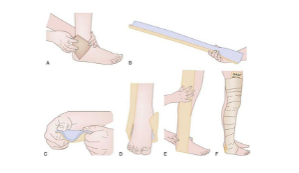 How to Splint Any Broken Bone | CU Wilderness Medicine